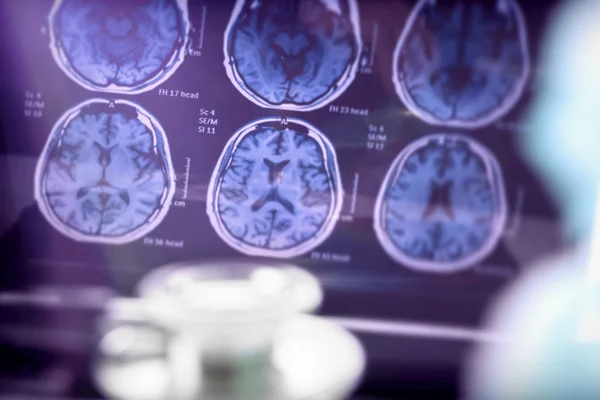 Neurologista explica quais são os sinais do início do Alzheimer