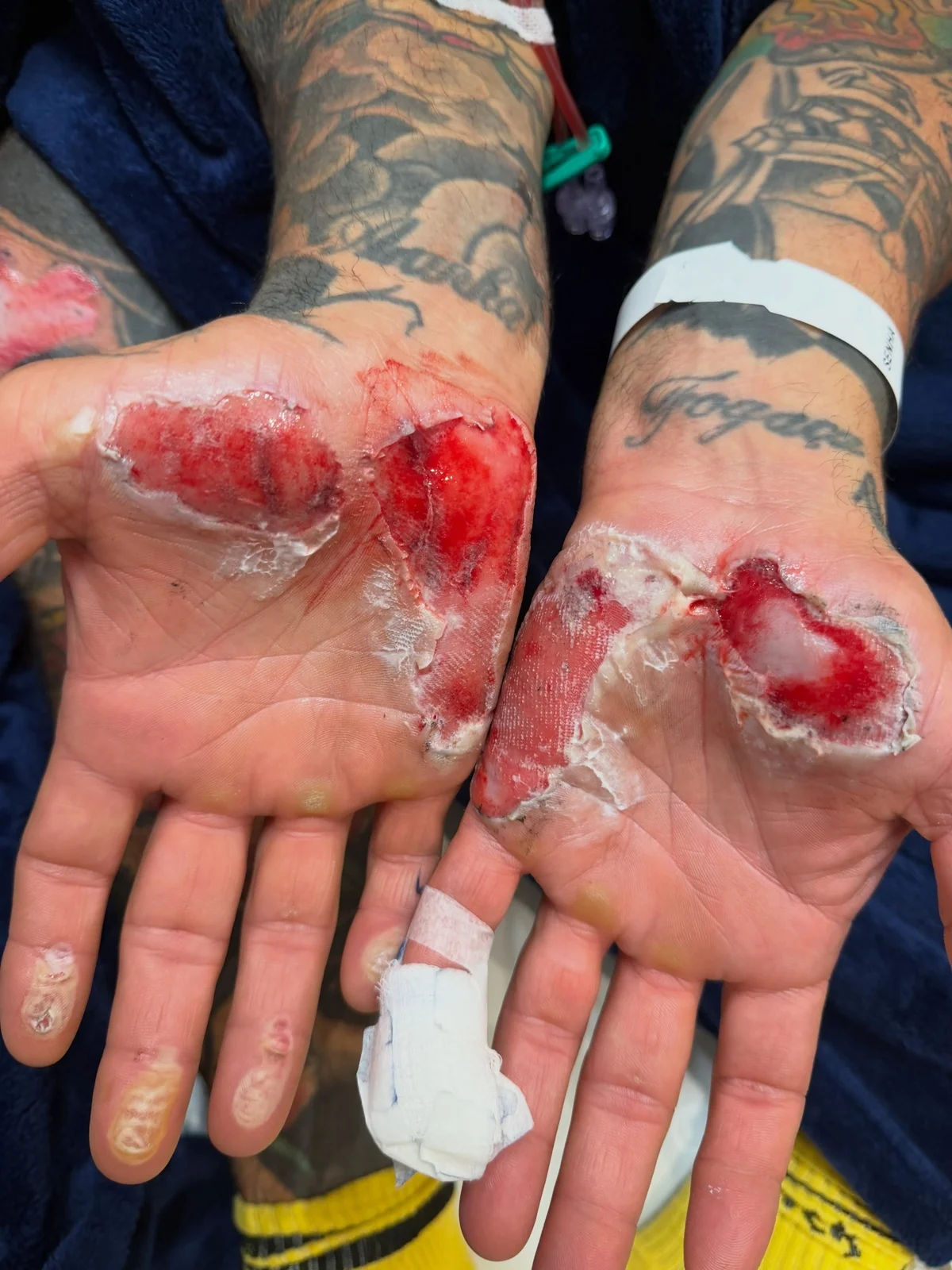 Chef Henrique Fogaça mostra lesões de acidente de moto que o afastou do MasterChef Chef Henrique Fogaça mostra lesões de acidente de moto que o afastou do MasterChef