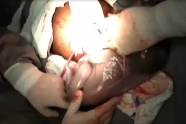 Bebê nasce dentro de saco amniótico em São Paulo. Veja vídeo