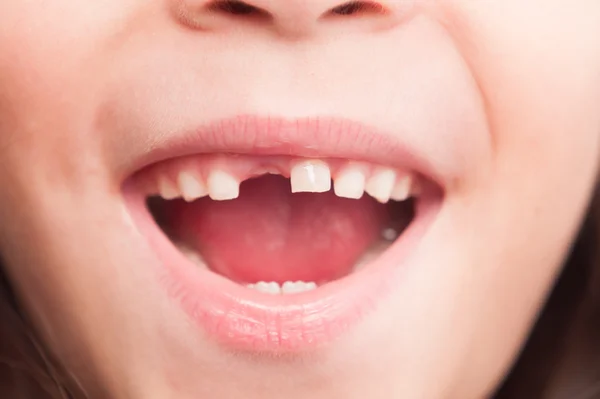 Imagem colorida de criança sem dente - Metrópoles