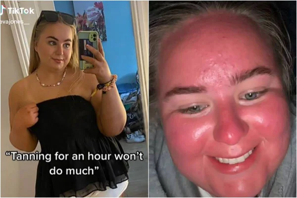 Britânica Eva Jones gravou vídeo no TikTok para mostrar insolação em onda de calor que fez seu rosto dobrar de tamanho. Nas fotos justapostas, ela mostra como estava seu rosto antes em foto no espelho, com seu celular (esquerda) e seu rosto após a insolação, queimado e inchado (direita) - Metrópoles
