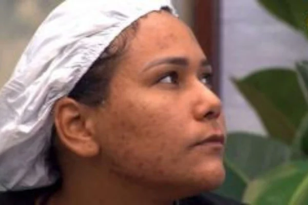 Pele acneica como a de Chaiany do BBB 26? Veja como cuidar
