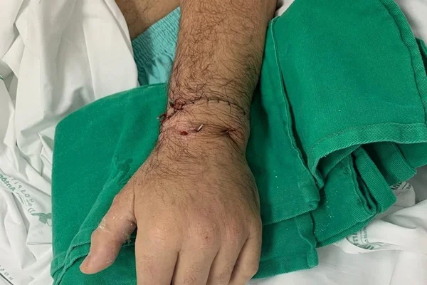 Após ter mão decepada em briga, homem tem membro reimplantado em cirurgia
