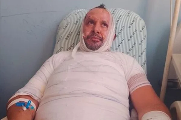 Imagem colorida, homem queima quase todo corpo ao acender churrasqueira com álcool - Metrópoles
