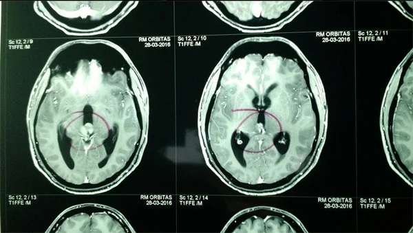 Cientistas conseguem detectar Parkinson 20 anos antes dos sintomas