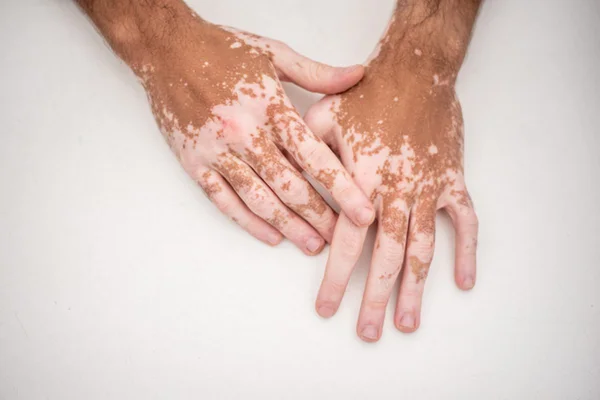 Imagem colorida: mãos de homem com vitiligo - Metrópoles