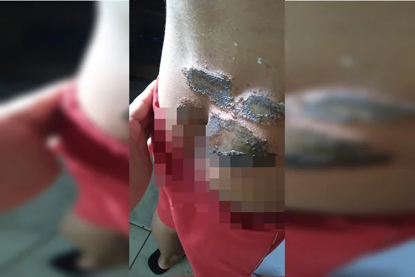 Família denuncia que criança teria sido queimada por colegas em escola