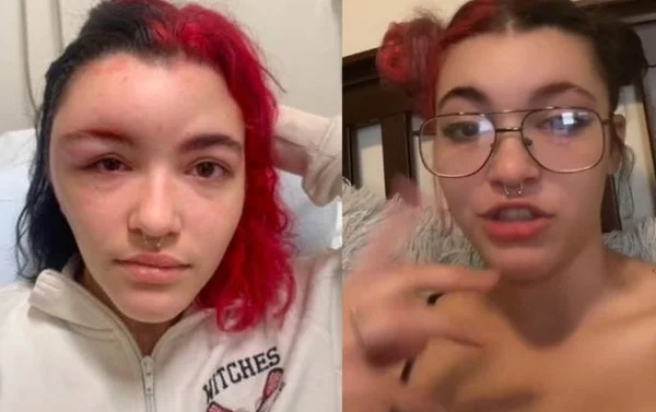 jovem com rosto inchado