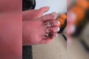 A condição rara deixou feridas nos pés de Rachel 