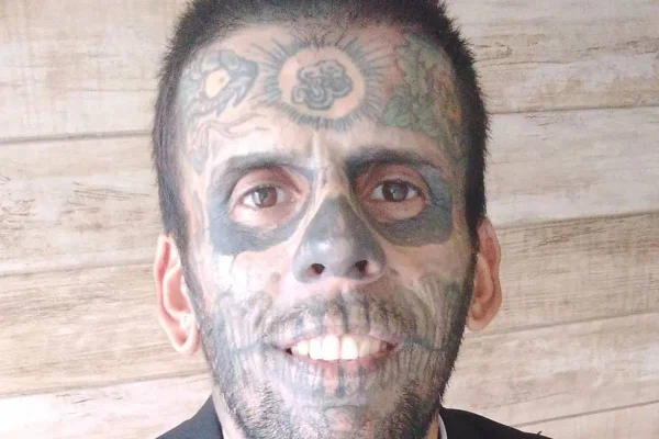 Antes e depois: homem mais tatuado do Brasil está na 2ª sessão de remoção de tatuagens - Metrópoles