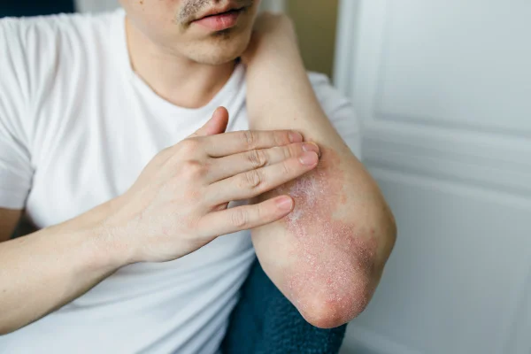 Homem que utiliza pomadas, cremes no tratamento de eczema, psoríase e outras doenças de pele como fungos, placas, erupções cutâneas e manchas.