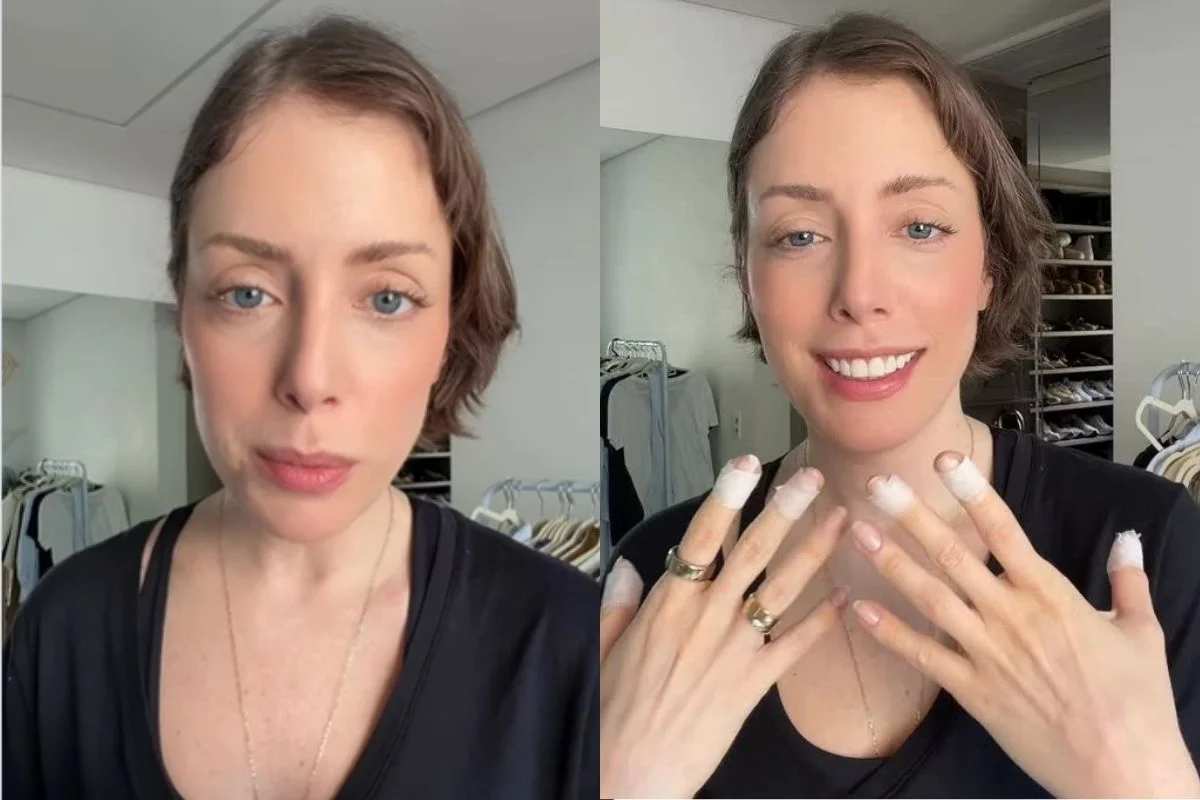 Fabiana Justus revelou o diagnóstico de dermatilomania Fabiana Justus revelou o diagnóstico de dermatilomania