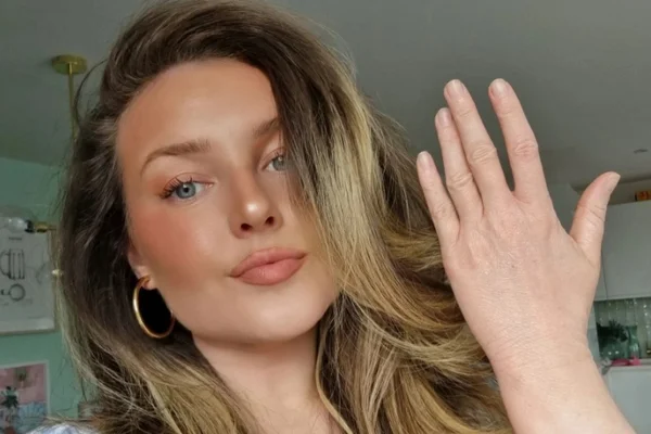 “Mãos de avó”: mulher de 28 anos fica com pele envelhecida após eczema
