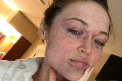 Mulher tem vasos sanguíneos do rosto rompidos em parto