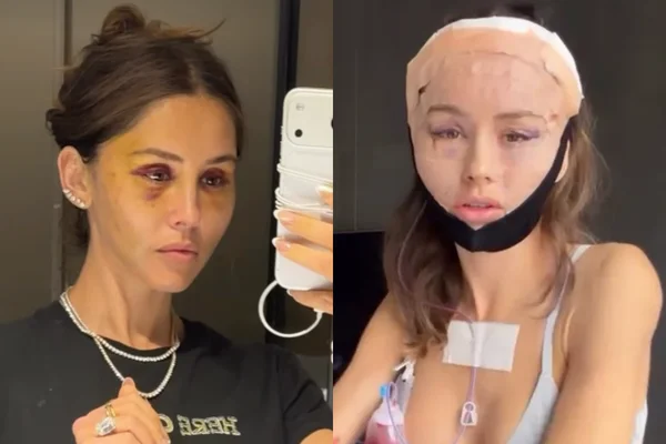 Jovem fica tão inchada após plástica que celular não a reconhece