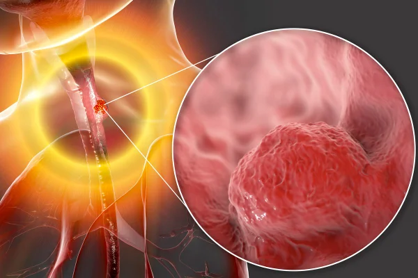 Ilustração mostra um esôfago e o zoom de uma massa cancerígena na região - Metrópoles