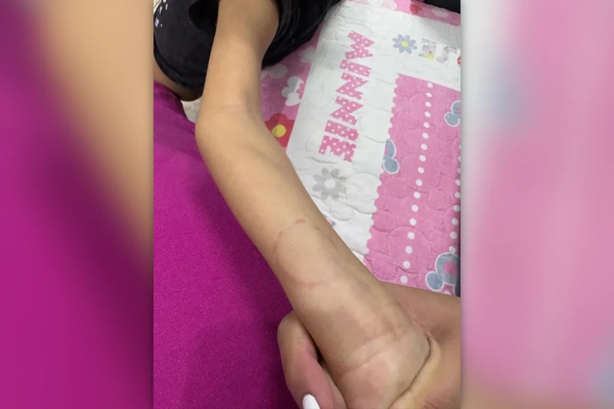 Segundo a mãe, a criança começou a chegar em casa com hematomas e mordidas Segundo a mãe, a criança começou a chegar em casa com hematomas e mordidas
