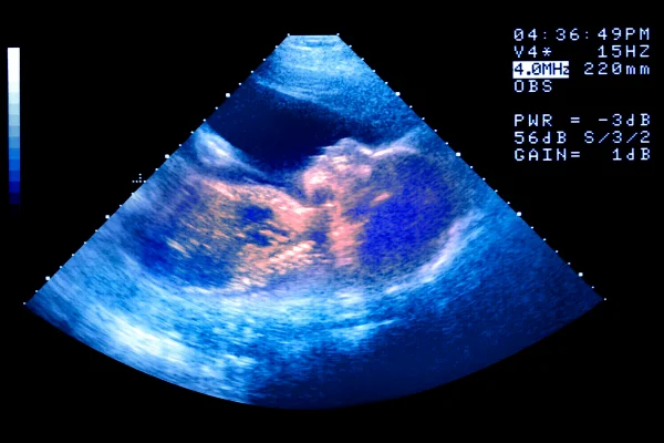 Imagem de ultrasonografia que mostram um bebê dentro da barriga - Metrópoles.