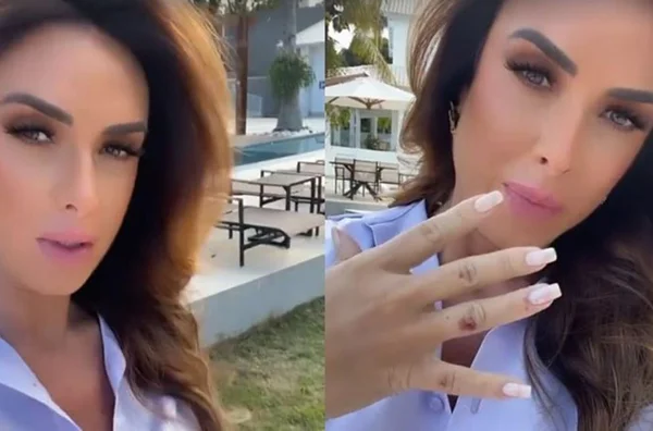 nicole bahls mostrando a mão machucada