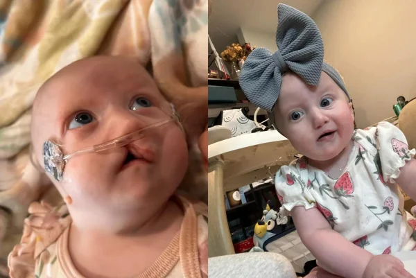 Bebê branca de olhos claros. Ela nasceu com doença rara. Metrópoles