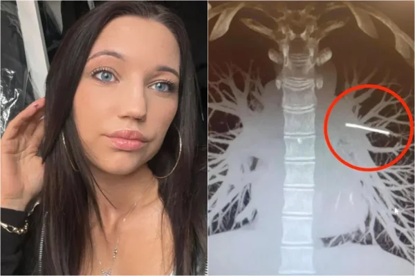 Duas fotos. Na primeira, mulher de cabelo preto, na segunda, implante anticoncepcional no pulmão - Metrópoles