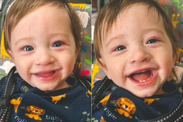Montagem de duas fotos com bebê branco, de olho azul e mostrando olhos vermelhos e com
