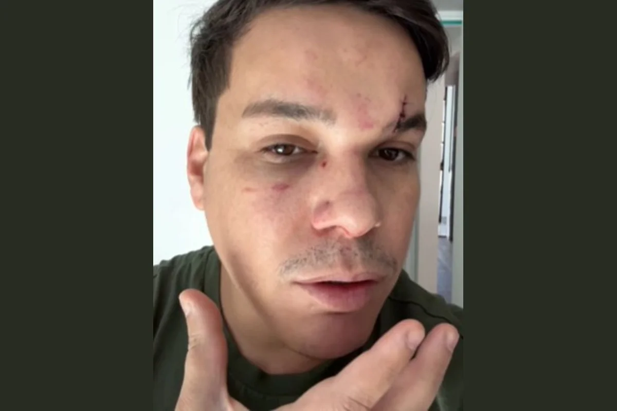 Vereador mostra lesões no rosto após agressão Vereador mostra lesões no rosto após agressão