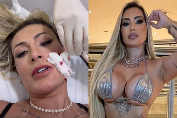 “Poderia ter me deixado cega”, diz Urach após levar quatro pontos