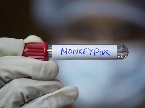 Foto colorida de profissional de saúde usando luvas segurando tubos de amostra rotulados como 'Varíola dos Macacos" mpox - Metrópoles