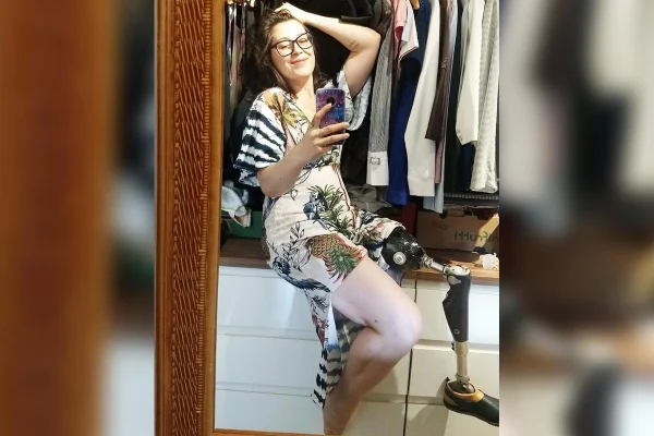 A jornalista Elizângela Toniolo, que perdeu uma perna por causa de um tumor
