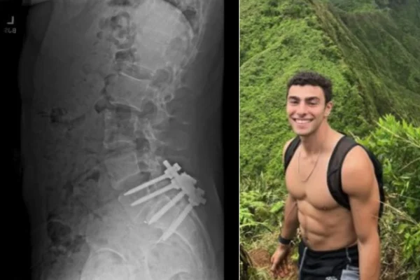 Imagem colorida de suspeito de assassinar CEO - Metrópoles - Luigi Mangione que tem espondilolistese