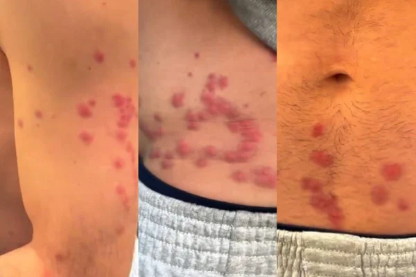 Imagens de manchas avermelhadas em braço e tronco de homem branco - Metrópoles