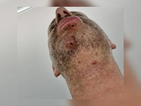 homem mostra feridas no pescoço e nos lábios causadas pelo vírus monkeypox