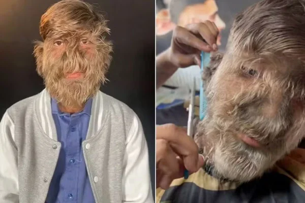 "Síndrome de lobisomem": jovem com rosto muito peludo vira influencer