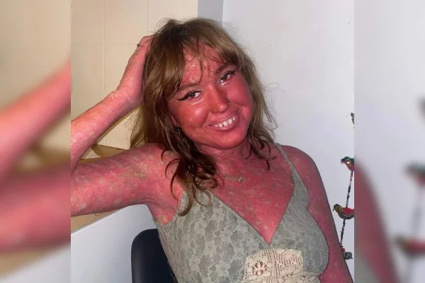Mulher jovem da Suíça tem aparência avermelhada e pálpebras voltadas para fora devido a doença de pele