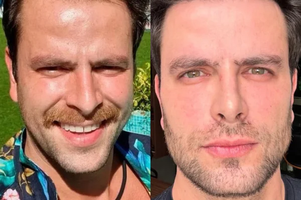 Trocou de rosto? Entenda a harmonização facial de Gustavo Marsengo - Metrópoles