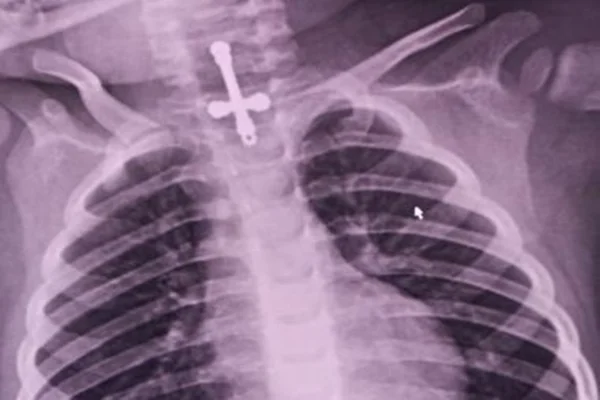Menino de 2 anos engole crucifixo que é retirado após intervenção médica