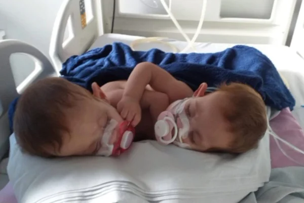 imagem coloridas, com as gêmeas siamesas lara e larissa, que estão em tratamento em goiânia goiás