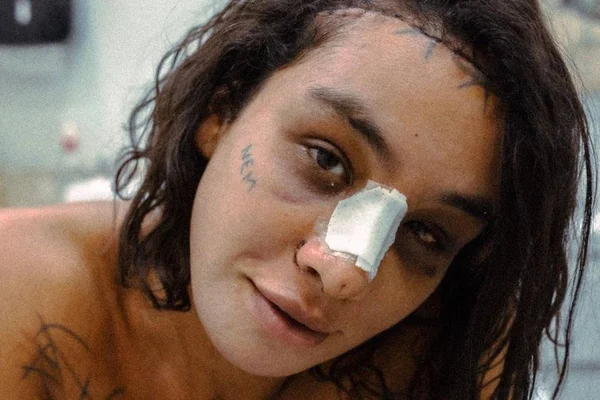 Linn da Quebrada faz cirurgia no rosto e mostra resultado: veja