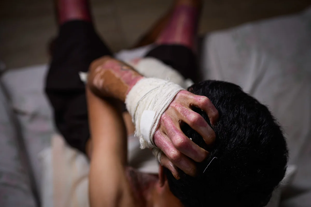 O trabalhador passou por quatro cirurgias durante os cerca de 26 dias em que ficou internado no Hran O trabalhador passou por quatro cirurgias durante os cerca de 26 dias em que ficou internado no Hran