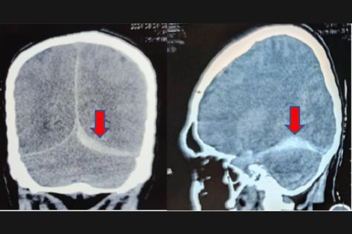 Um desvio da linha média do cérebro é visível na tomografia computadorizada Um desvio da linha média do cérebro é visível na tomografia computadorizada