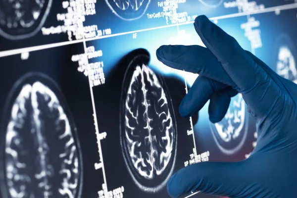 Pesquisa em Neurologia, Médico examinando uma tomografia cerebral humana na tela. Conceito de alzheimer ou demência. Metrópoles