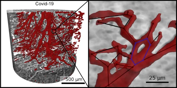 Imagem colorida de modelo 3D que mostram os impactos da Covid-19 no coração