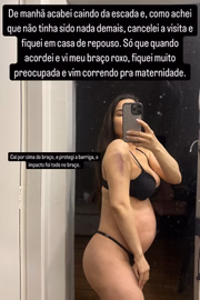 Raissa Barbosa mostrou a mancha roxa no braço após queda