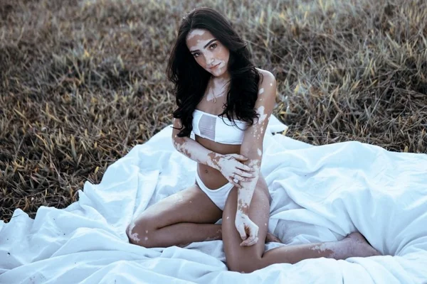 modelo com vitiligo Larissa Sampaio
