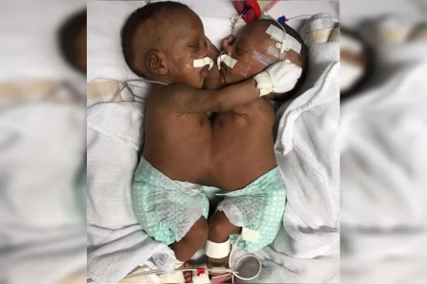 Gêmeos siameses recebem alta após cirurgia em Belo Horizonte