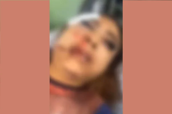 Garota de programa tem rosto desfigurado ao ser agredida por cliente