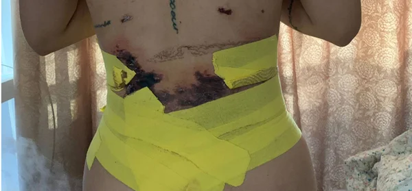 Necrose em mulher após lipoaspiração