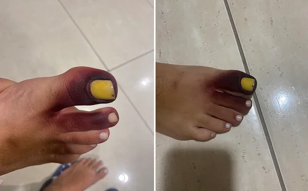 Mulher fica com dedos roxos após ter piolho-de-cobra preso no tênis