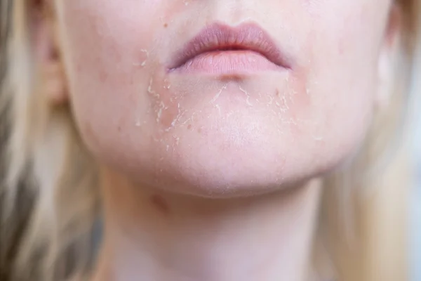 A pele da mulher descama na boca. Pele seca. Irritação na pele do rosto após descamação, após tempo frio e ventoso. Metrópoles
